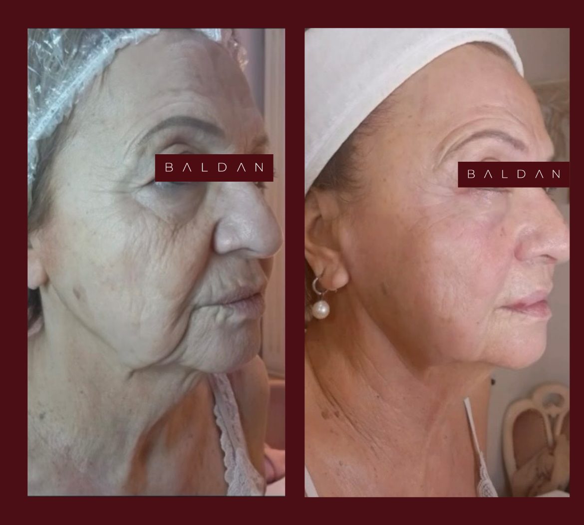 T-Face before and after — jawline